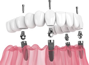 Digital image of implant denture