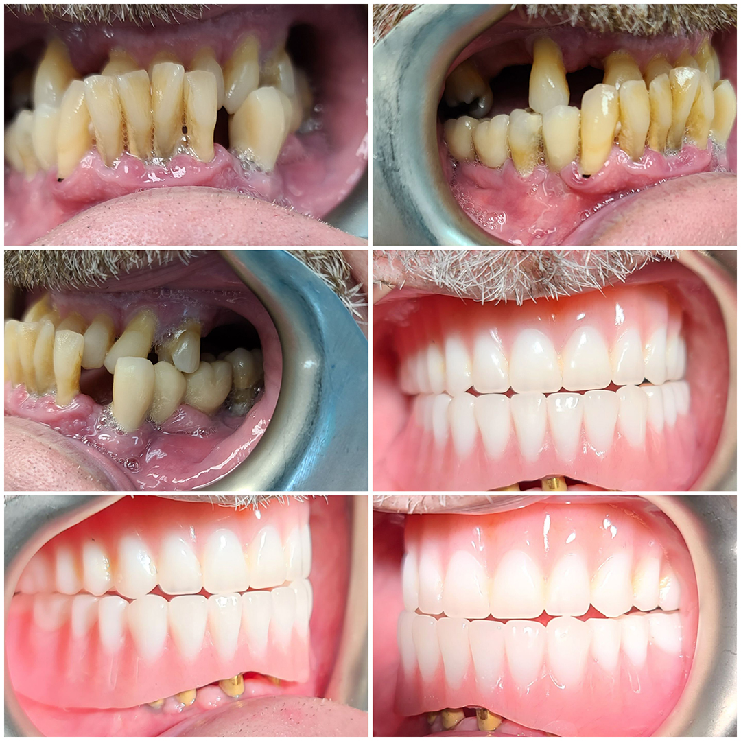 Dental Implants Before and After 5