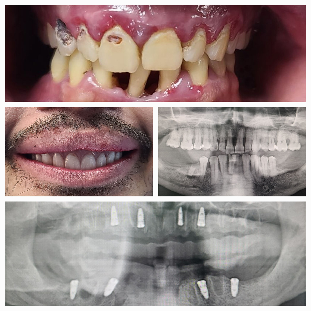 Dental Implants Before and After 6