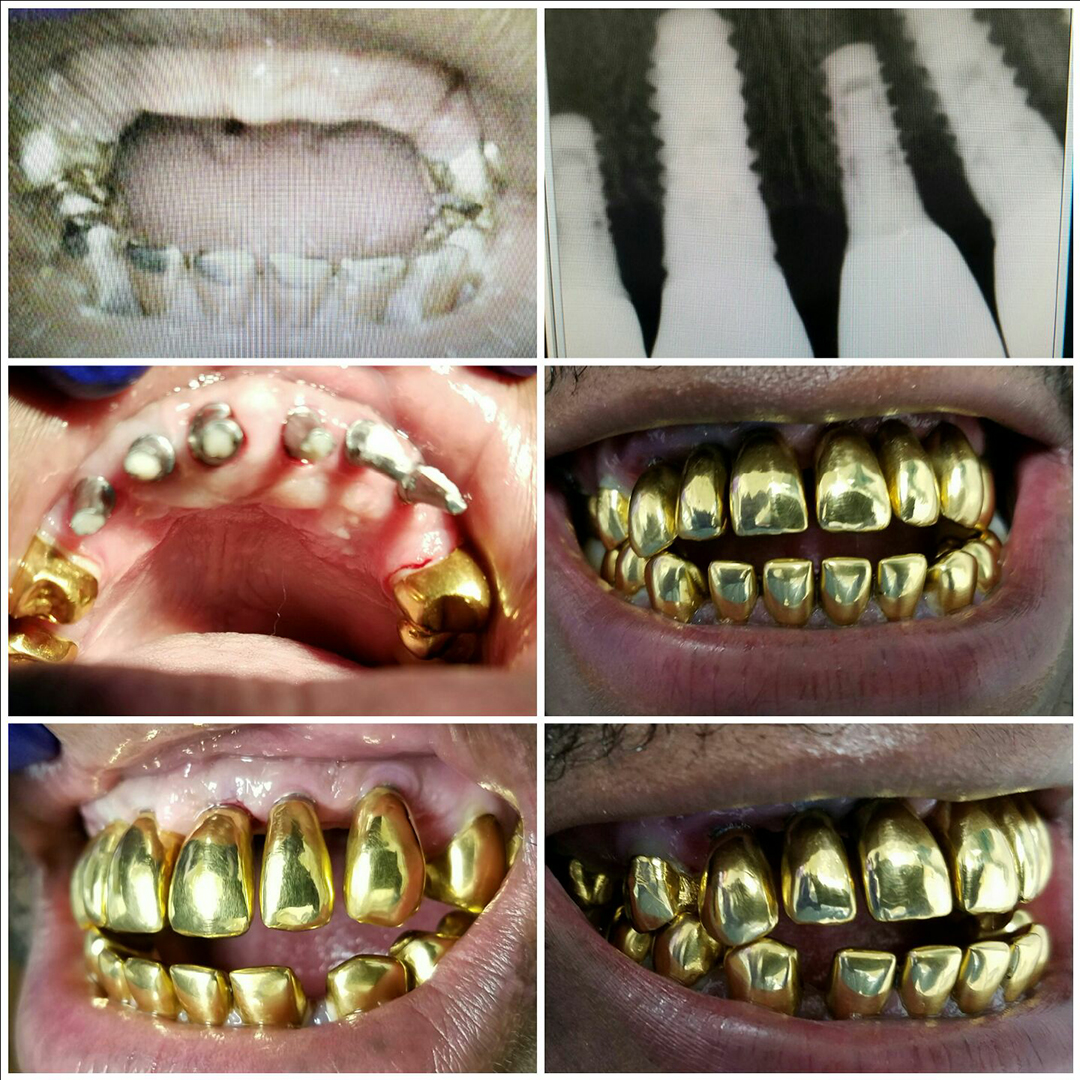 Dental Implants Before and After 8