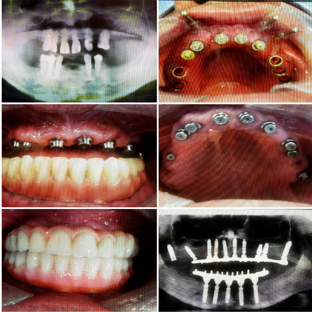 Dental Implants Before and After 9