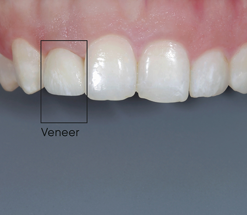Picture of teeth with veneer indicated