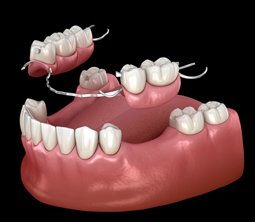 Illustration of partial denture being used to replace lower teeth